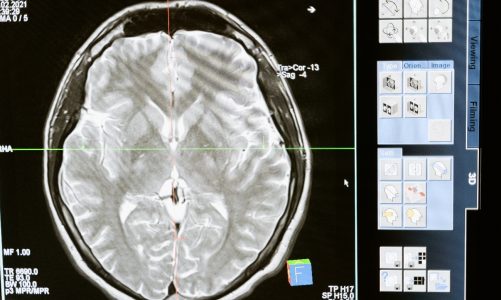1% dos internados tem complicações cerebrais pós-covid